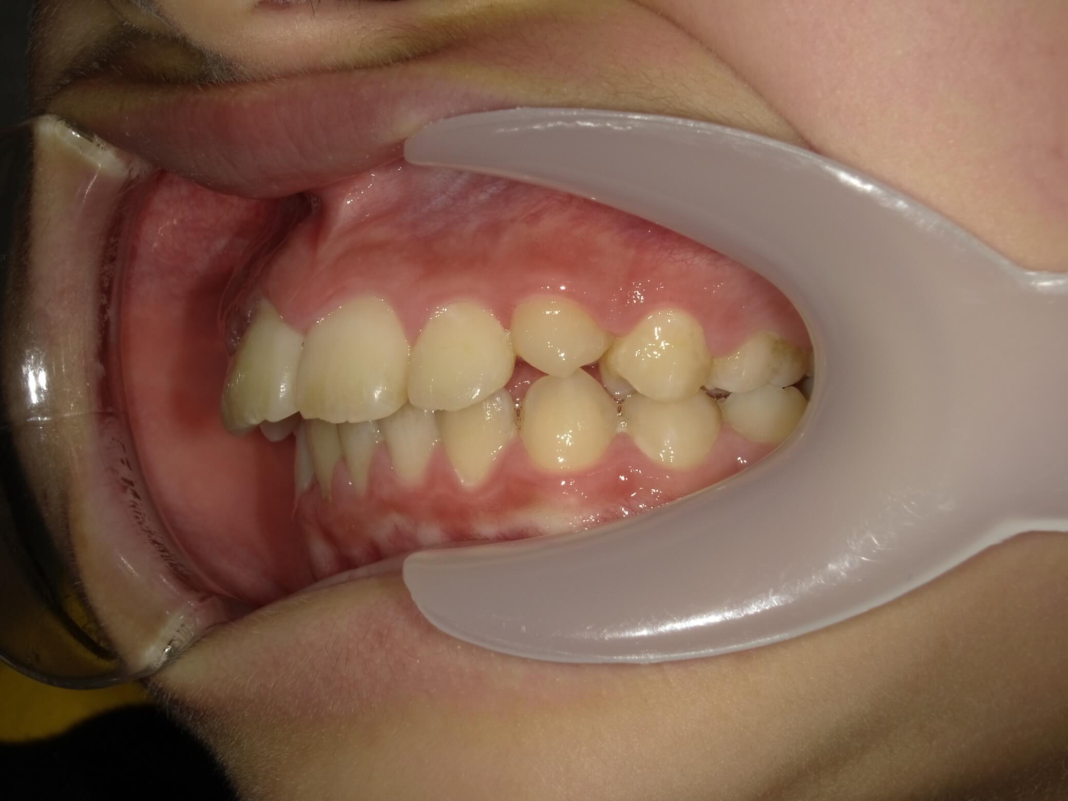 施術後の口内写真03