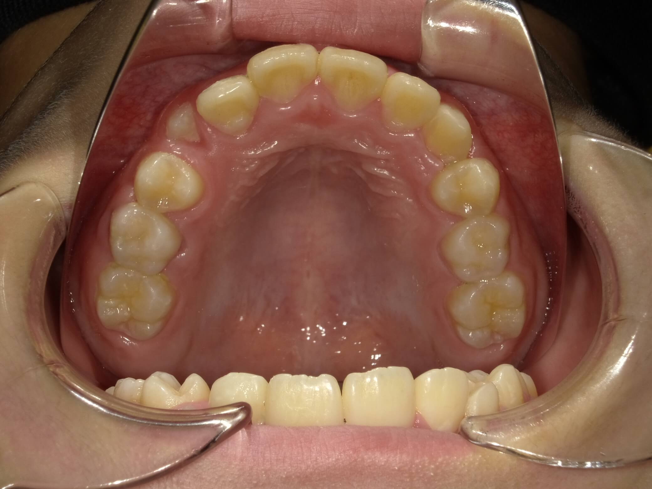 施術後の口内写真04