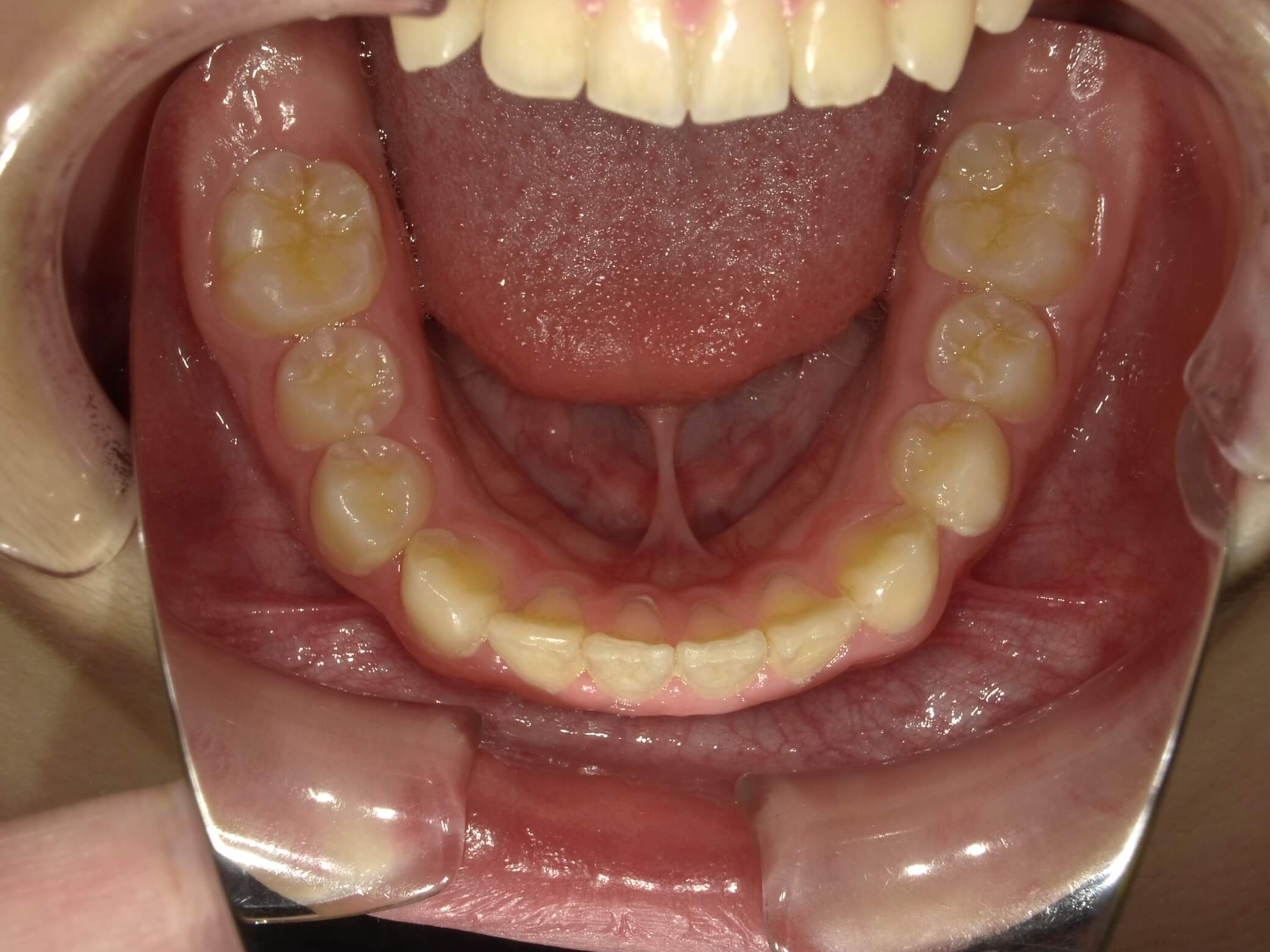 施術後の口内写真05