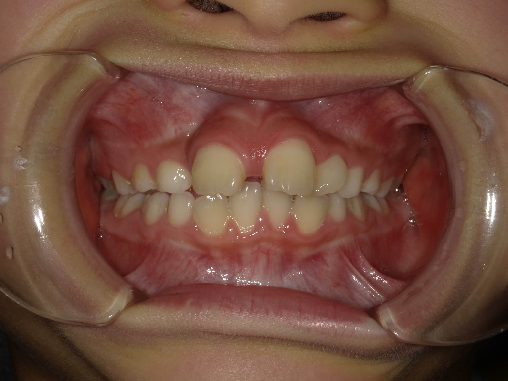 施術前の口内写真01
