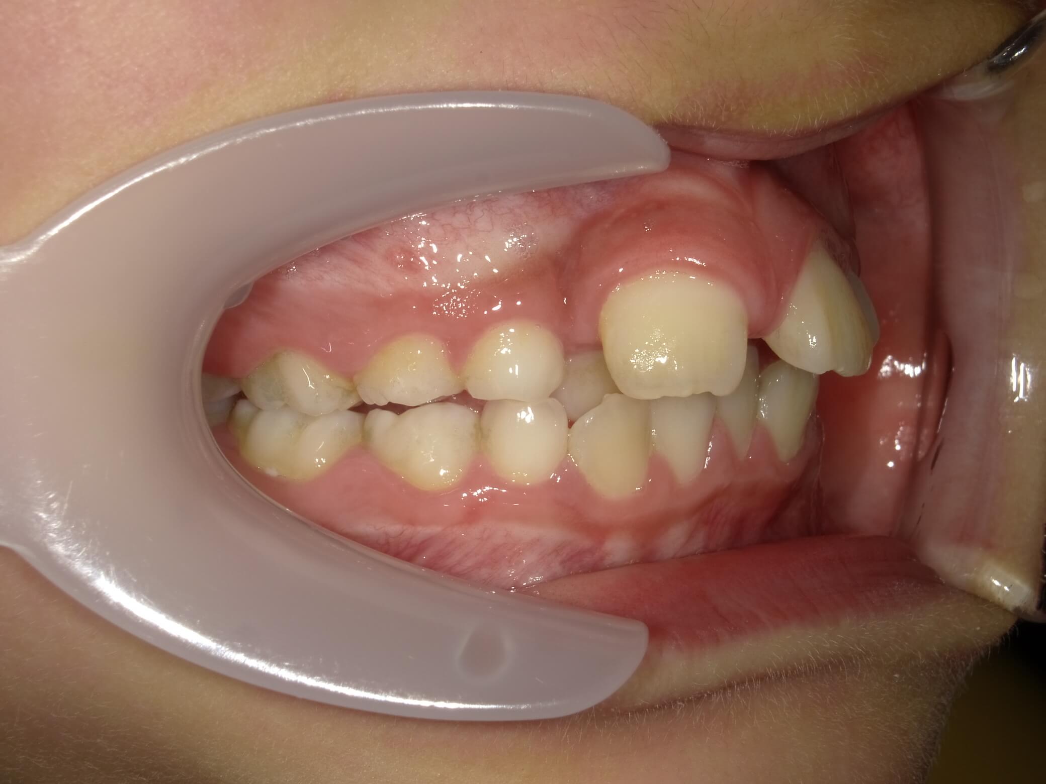 施術前の口内写真02