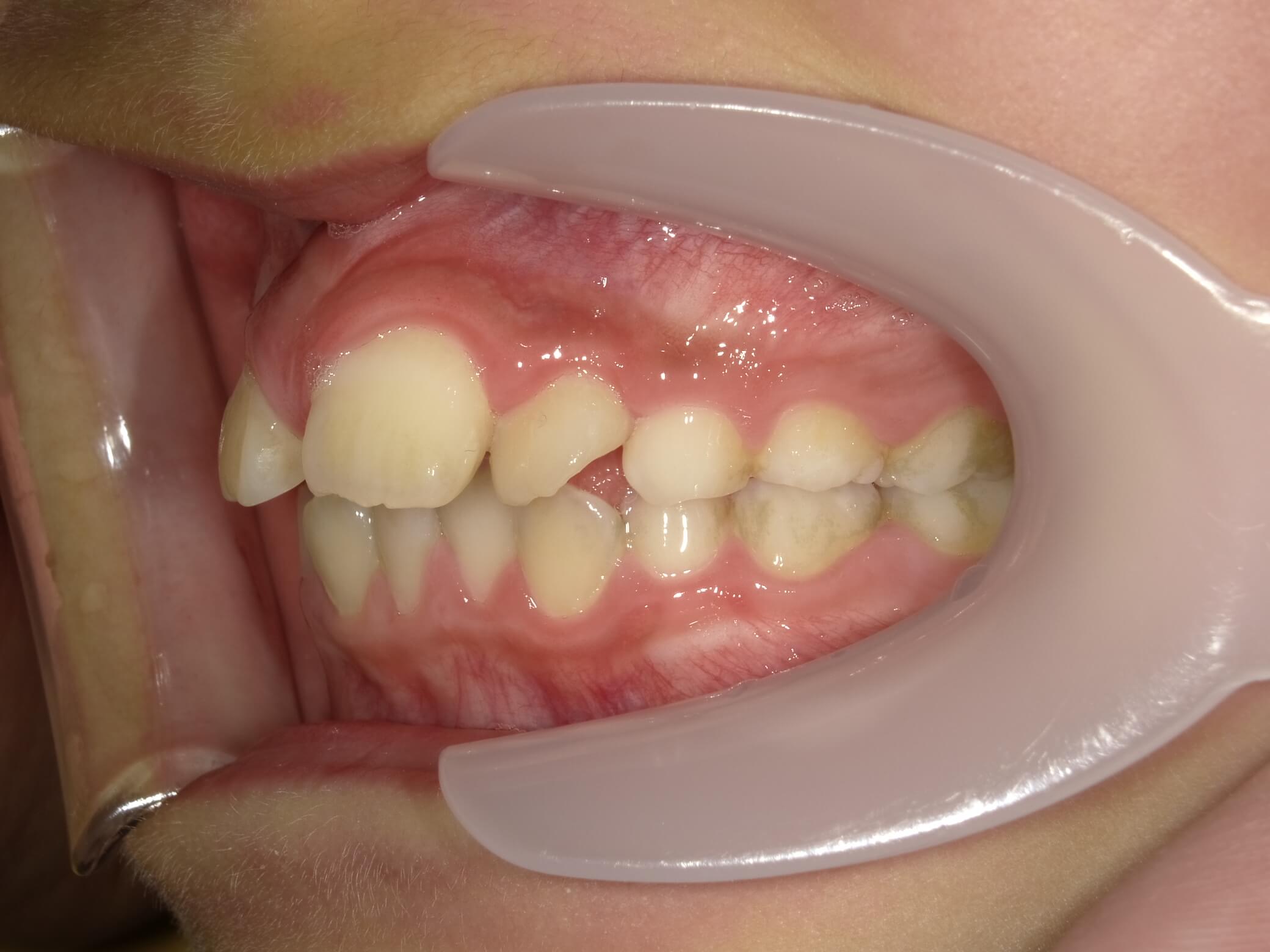 施術前の口内写真03
