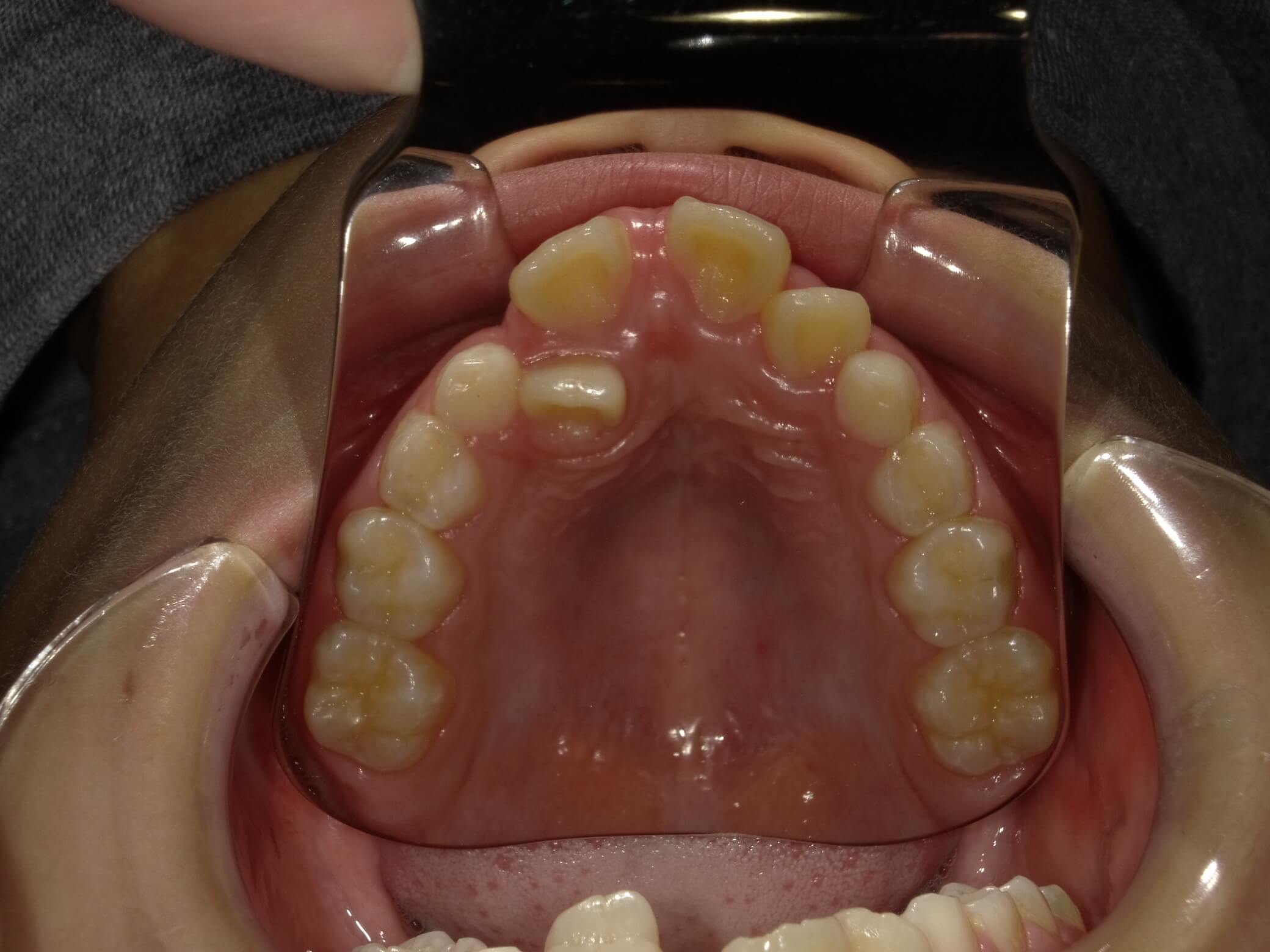 施術前の口内写真04