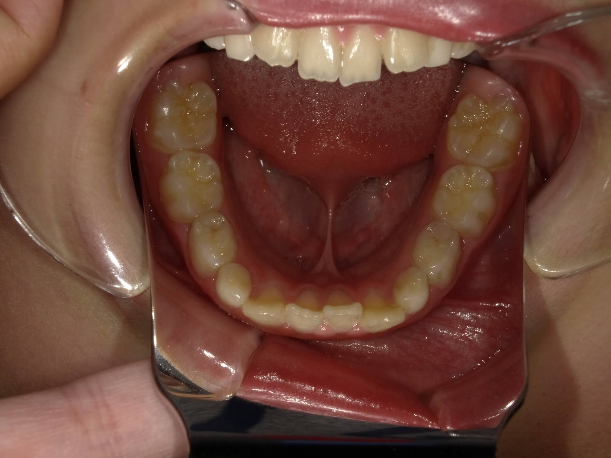 施術前の口内写真05