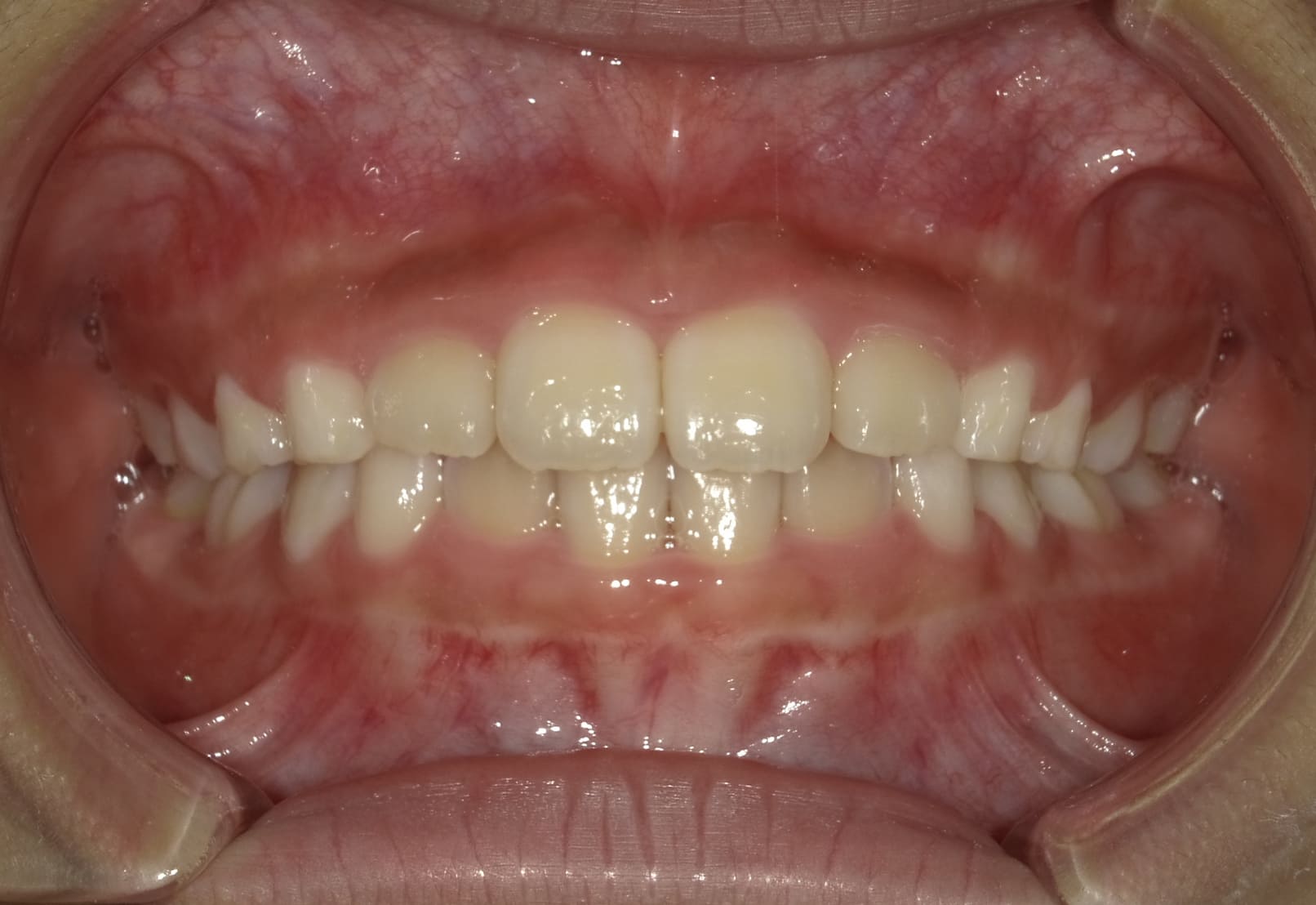施術後の口内写真01