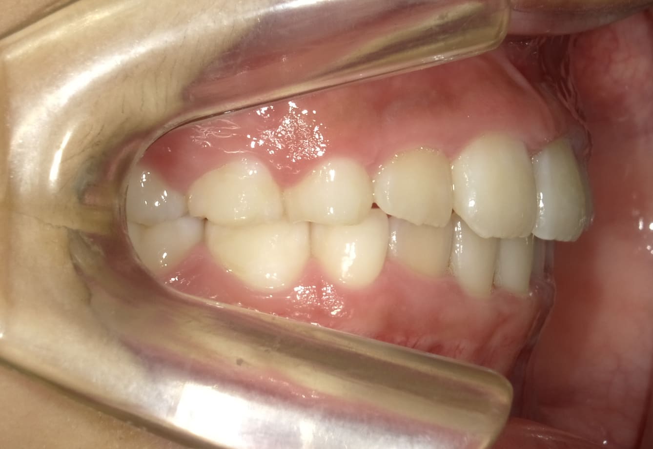 施術後の口内写真02