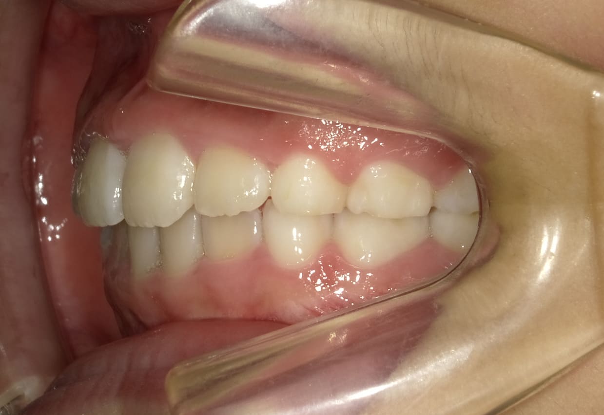 施術後の口内写真03