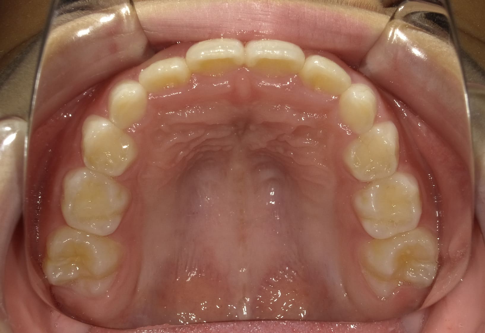施術後の口内写真04