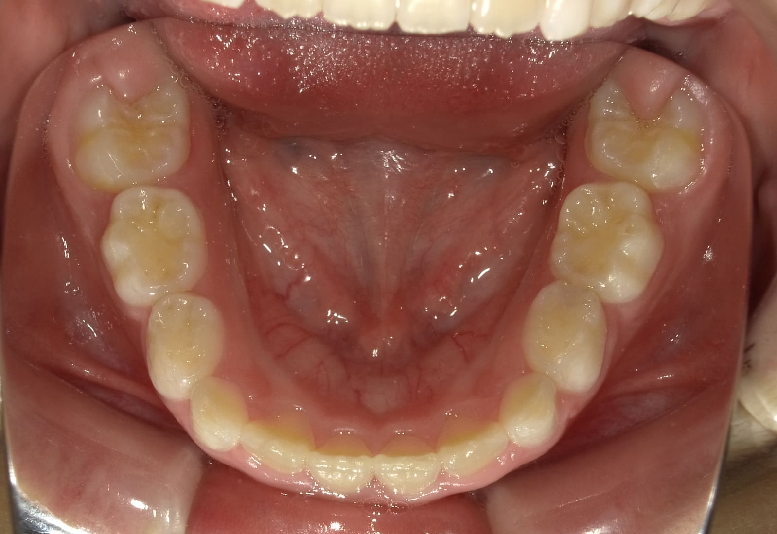 施術後の口内写真05