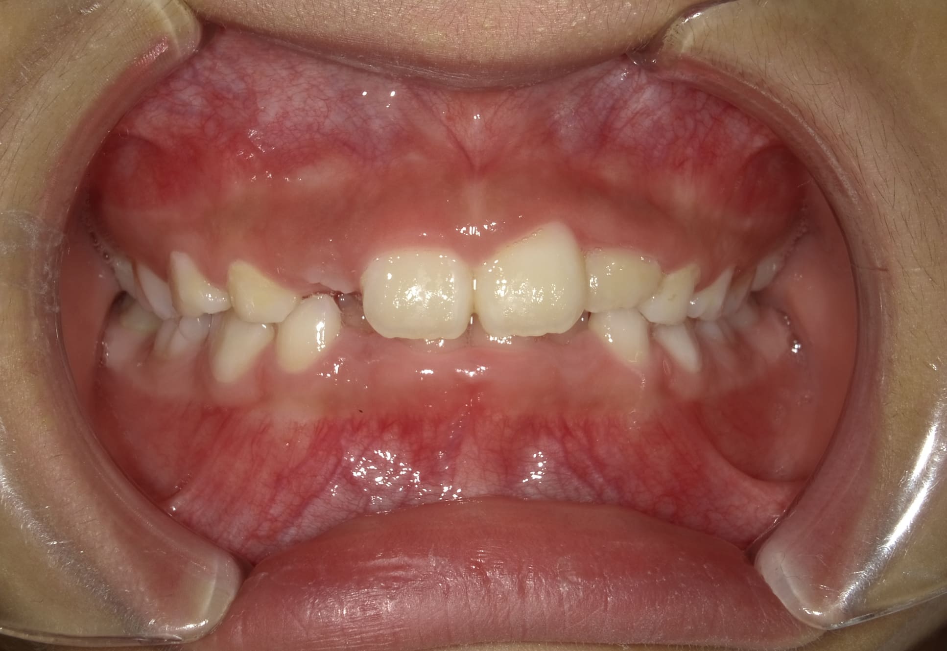 施術前の口内写真01