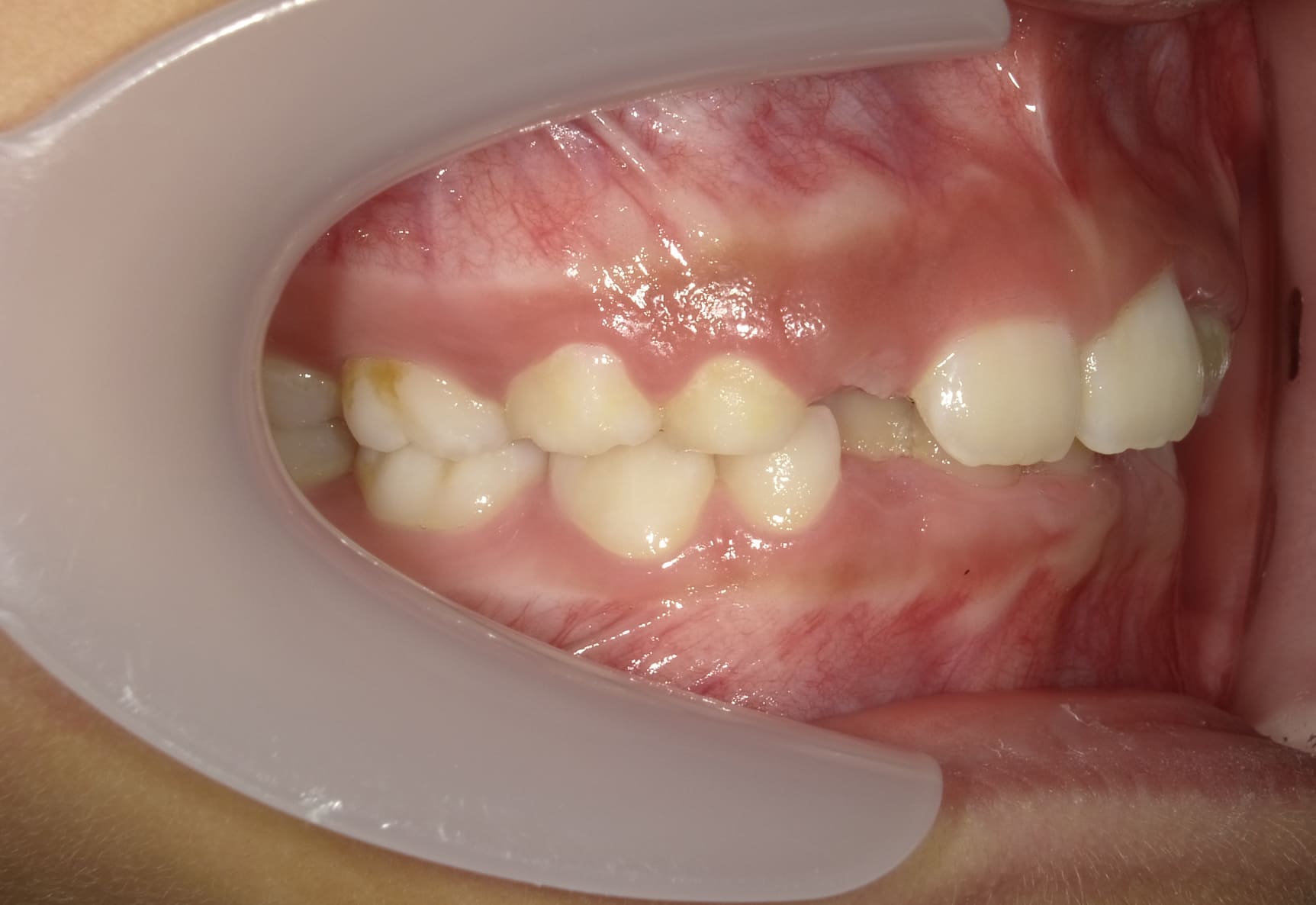 施術前の口内写真02
