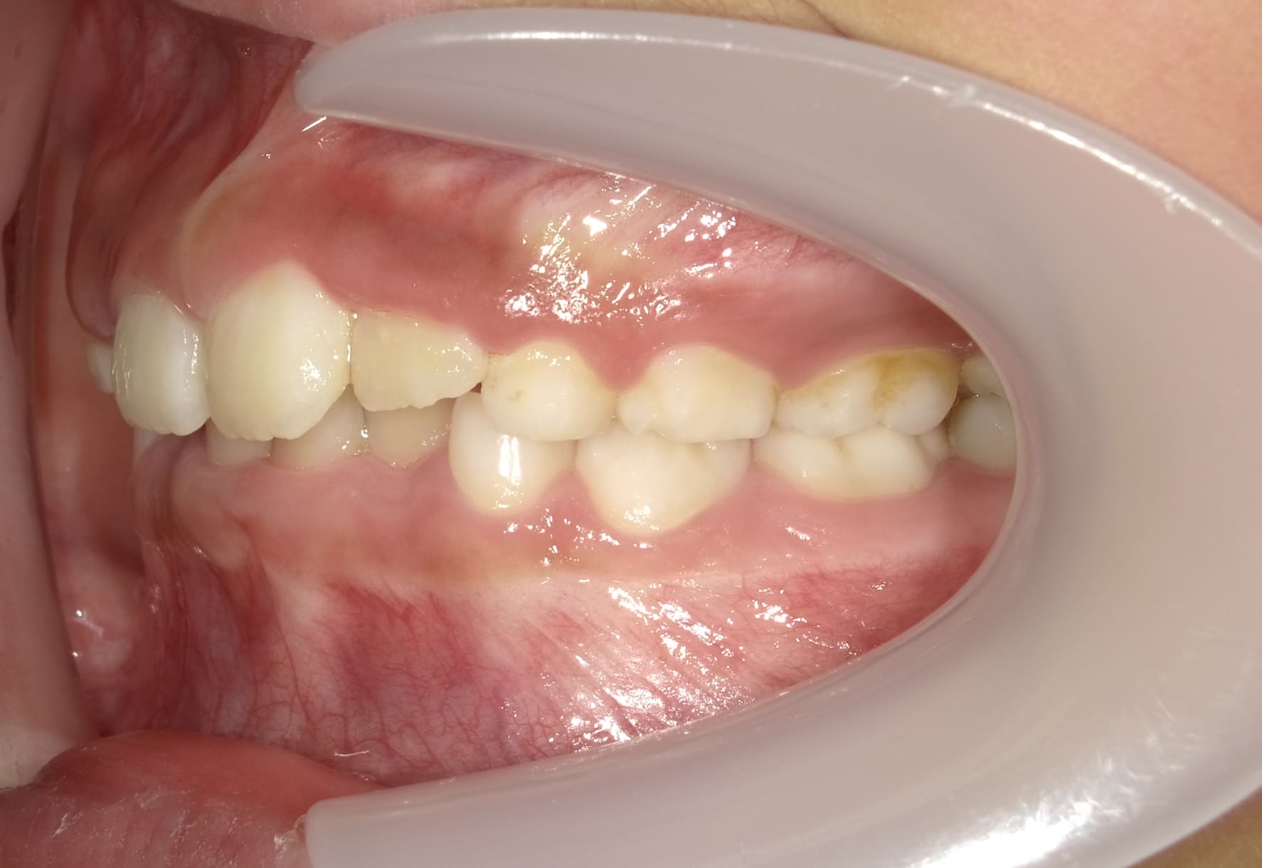 施術前の口内写真03