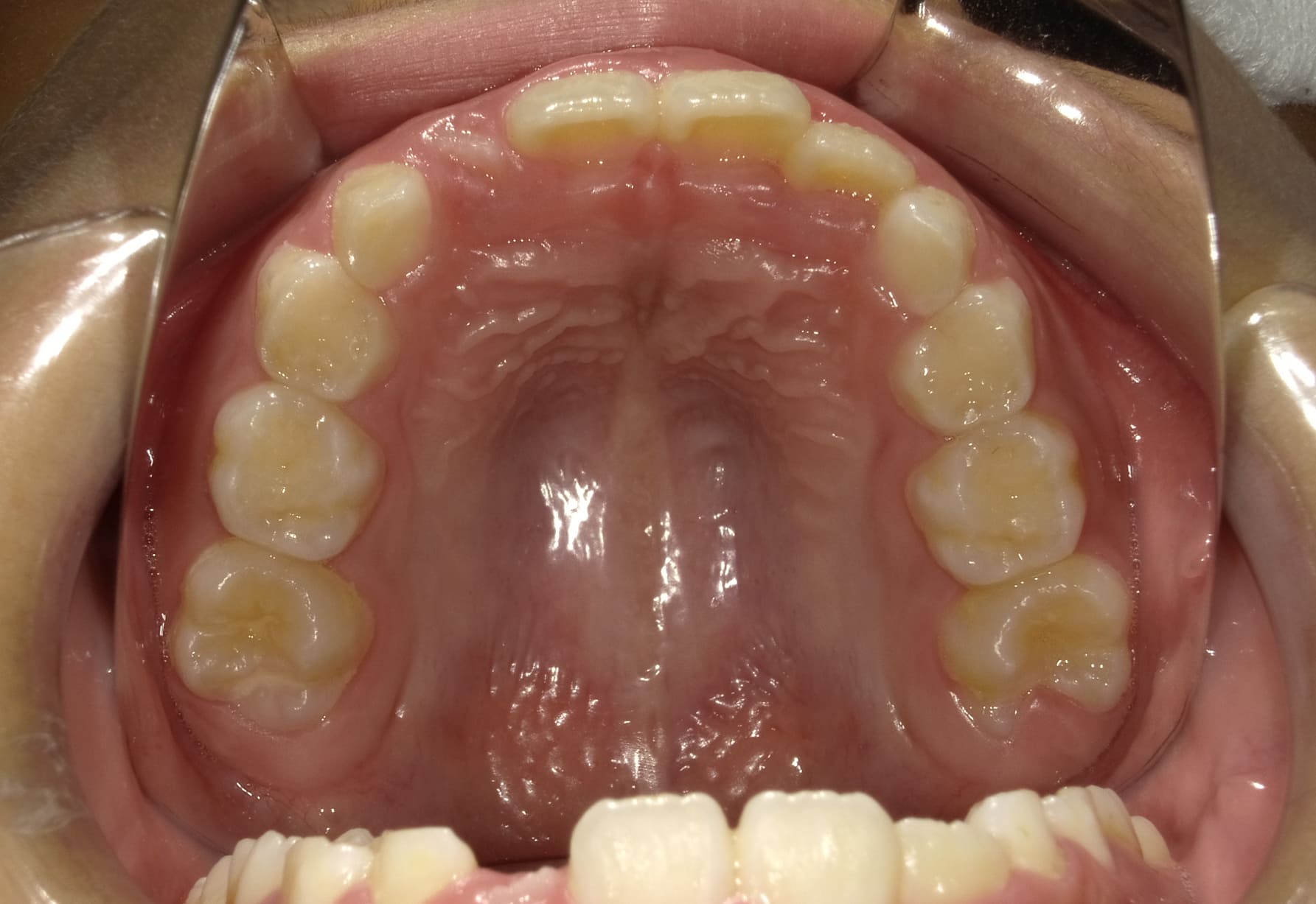 施術前の口内写真04