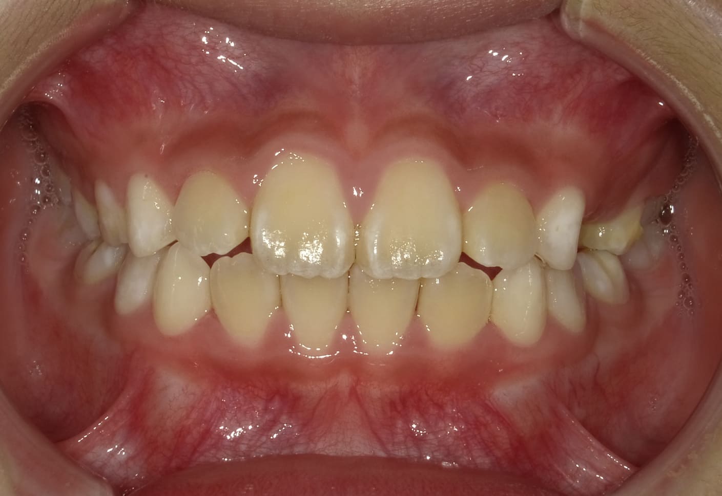 施術後の口内写真01