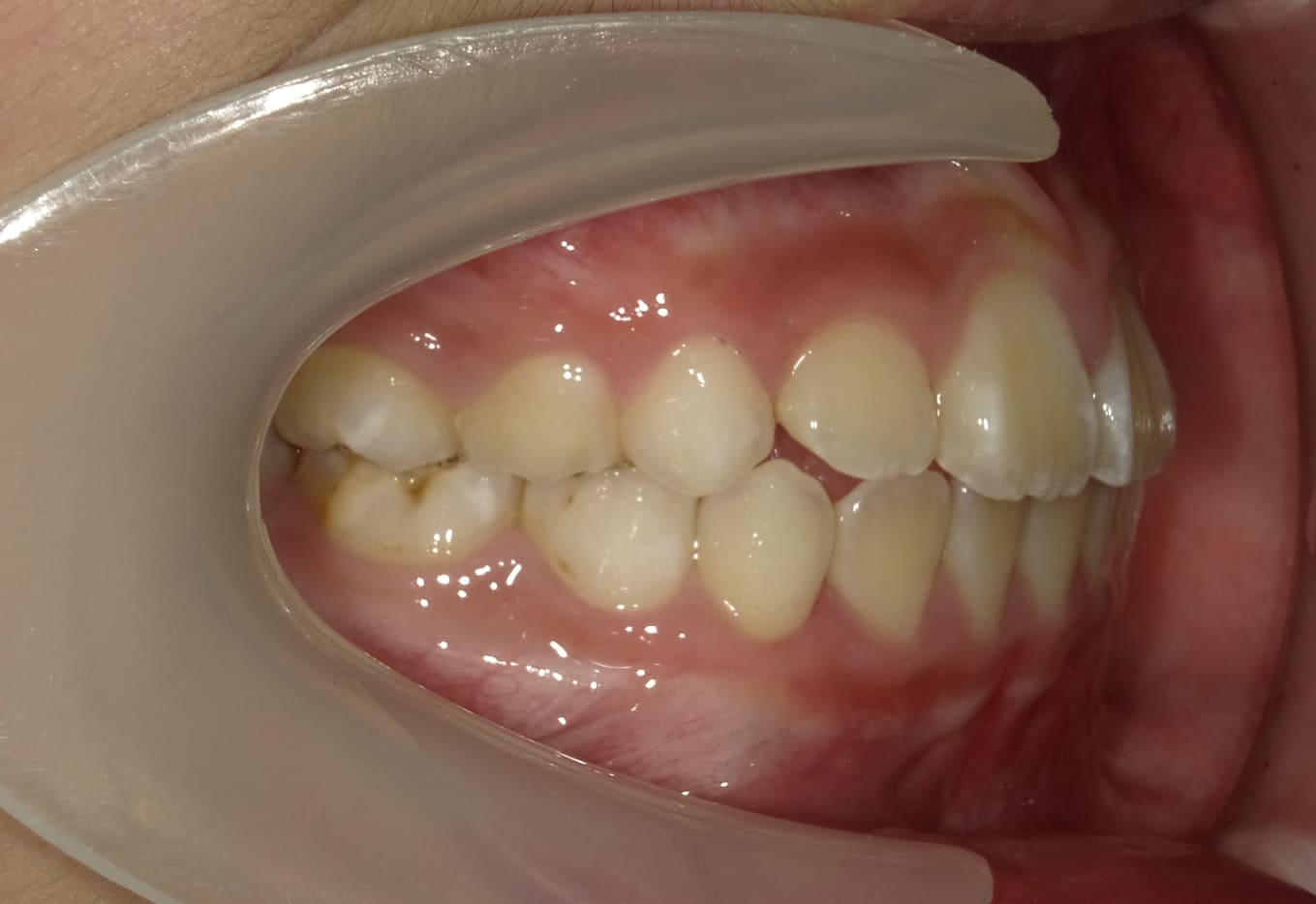 施術後の口内写真02
