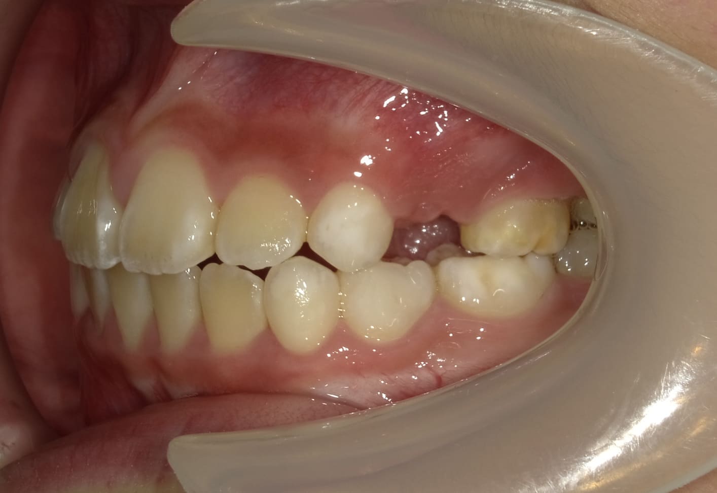 施術後の口内写真03