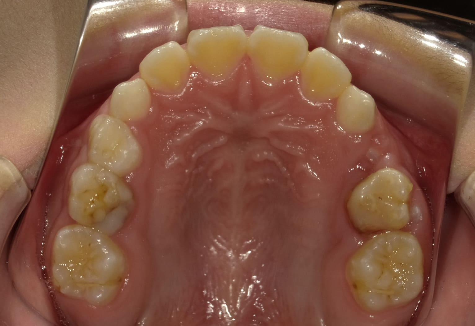 施術後の口内写真04