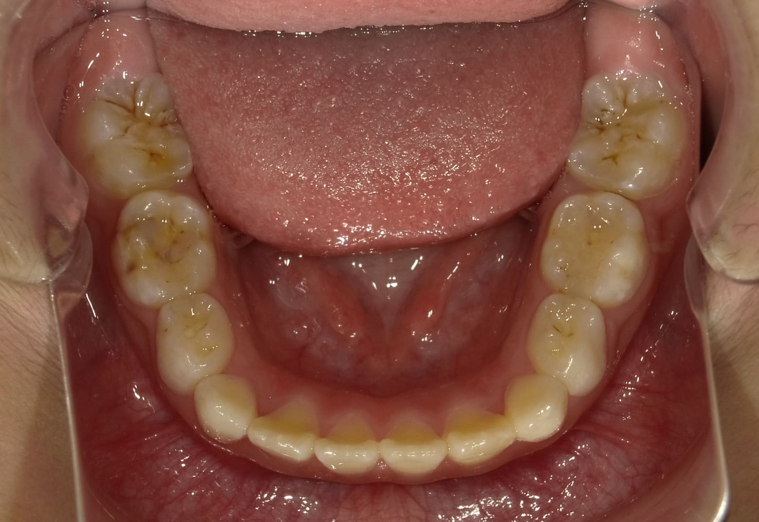 施術後の口内写真05