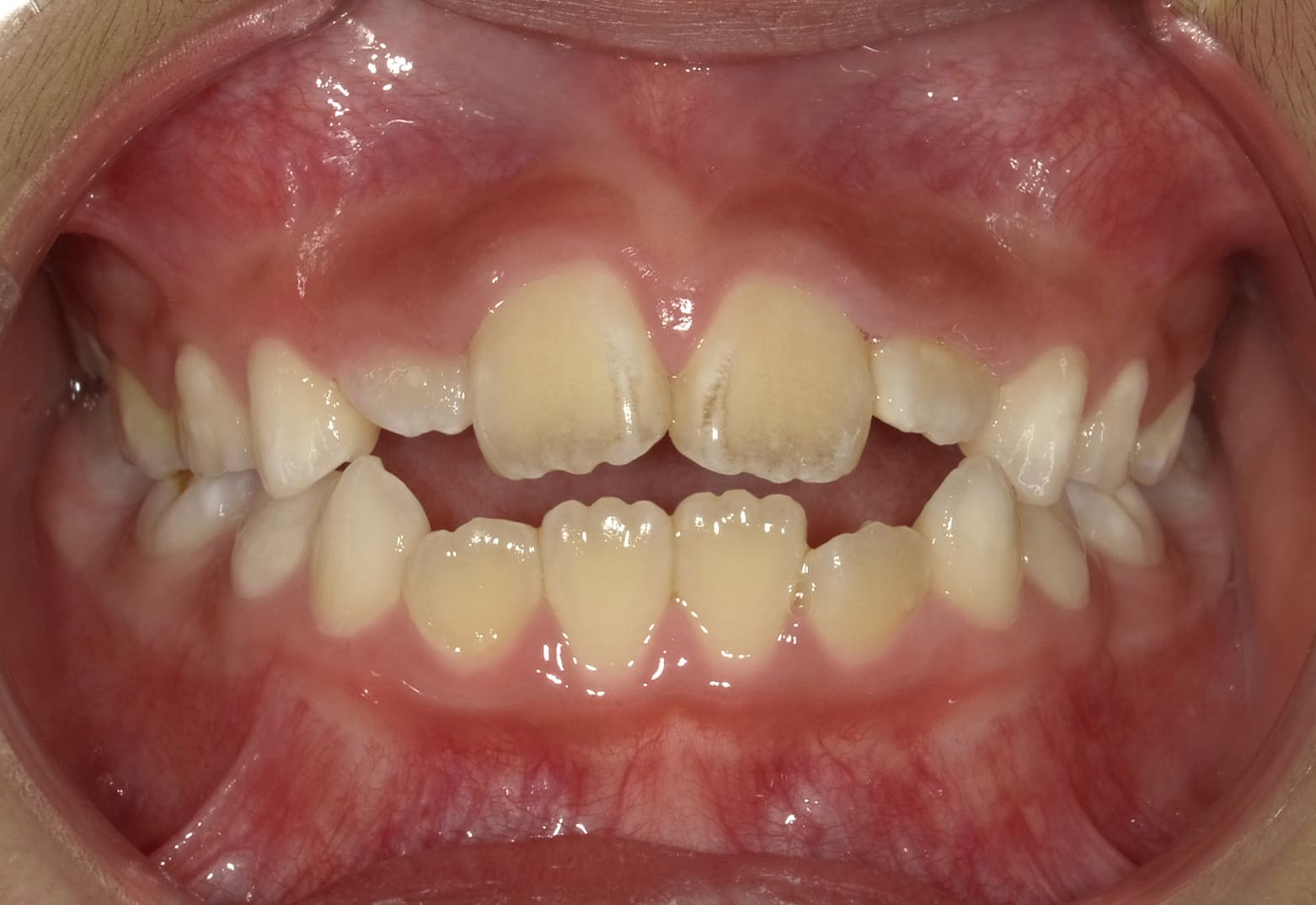 施術前の口内写真01
