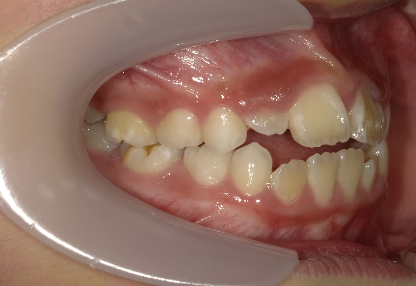 施術前の口内写真02