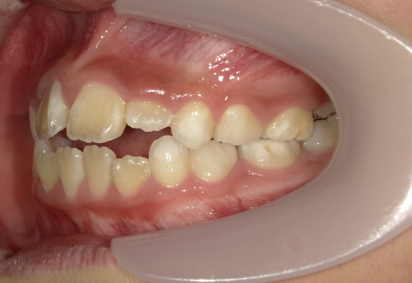 施術前の口内写真03