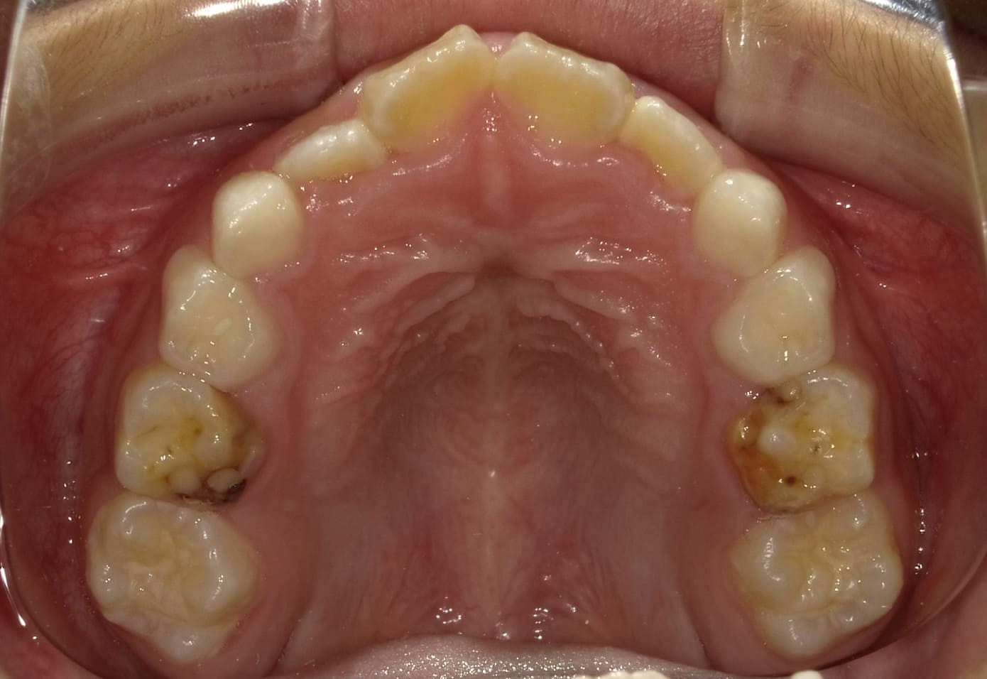 施術前の口内写真04