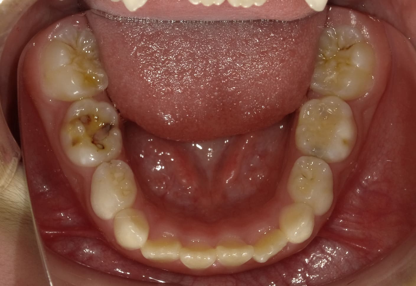 施術前の口内写真05