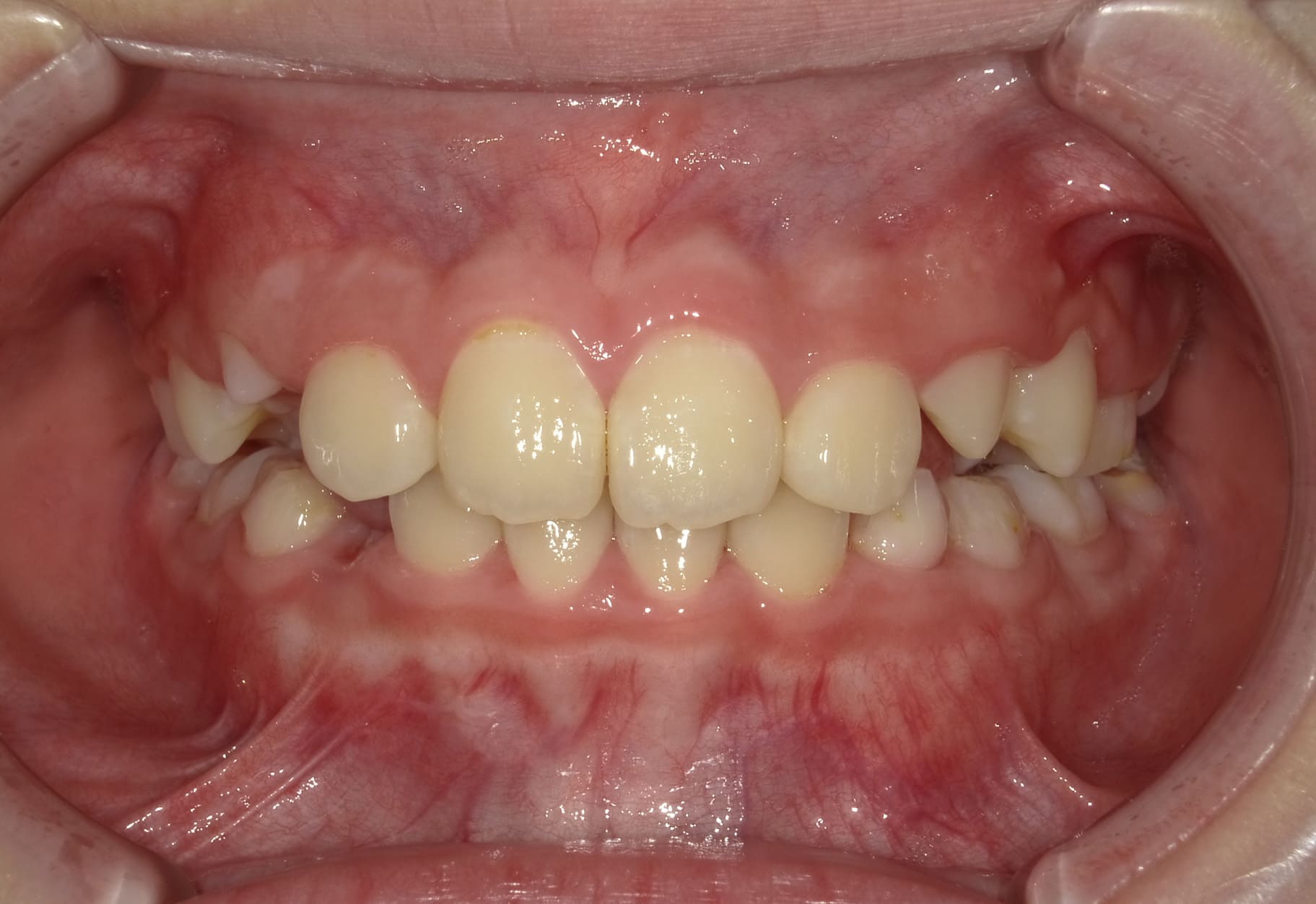 施術後の口内写真01