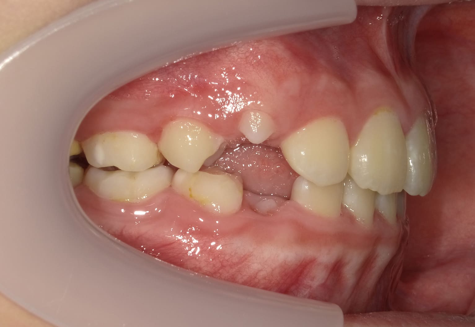 施術後の口内写真02