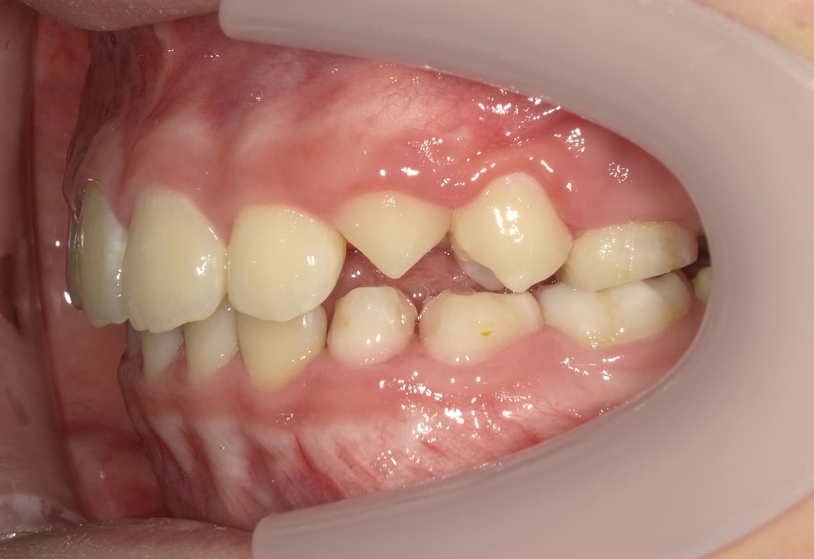施術後の口内写真03