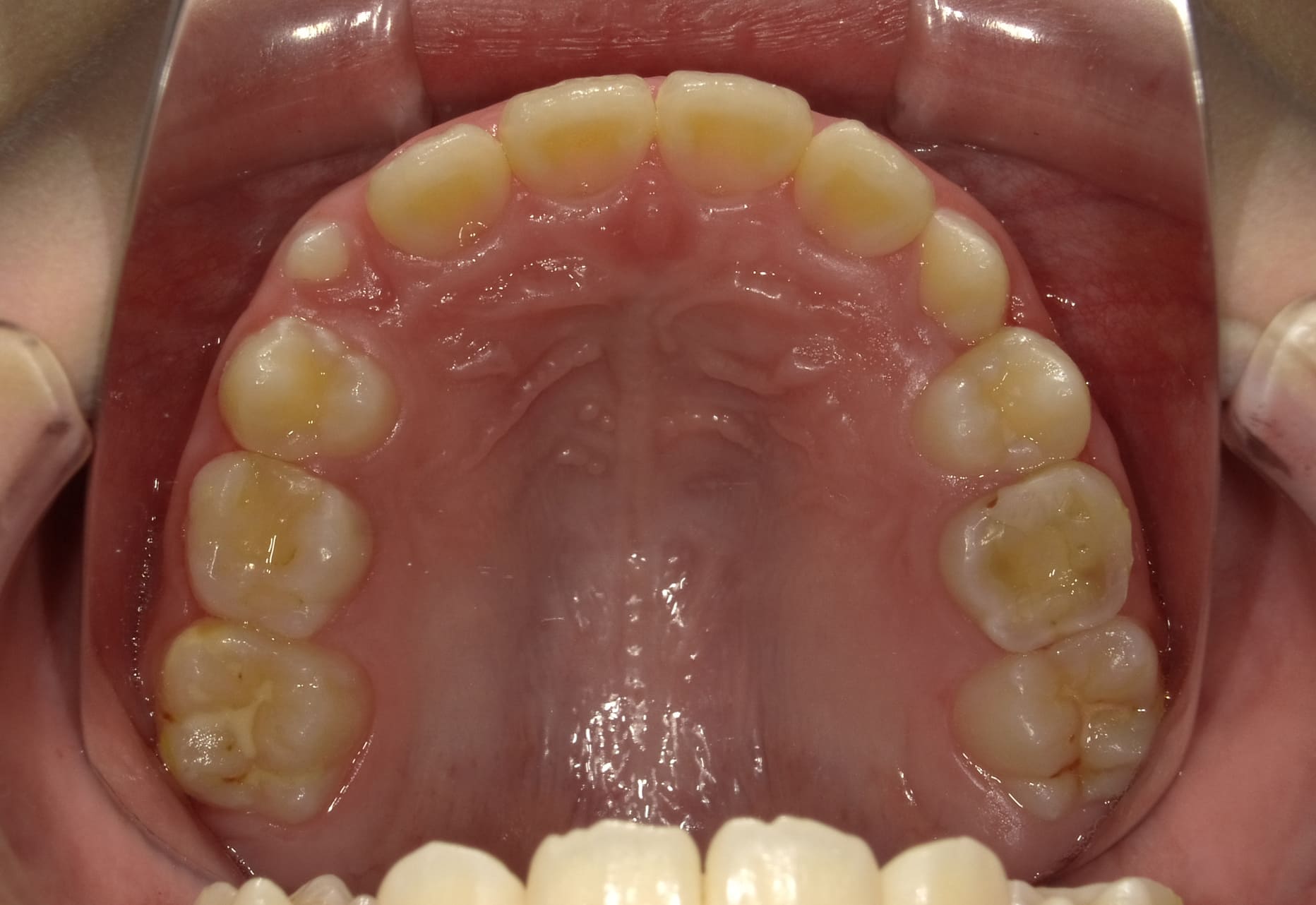 施術後の口内写真04