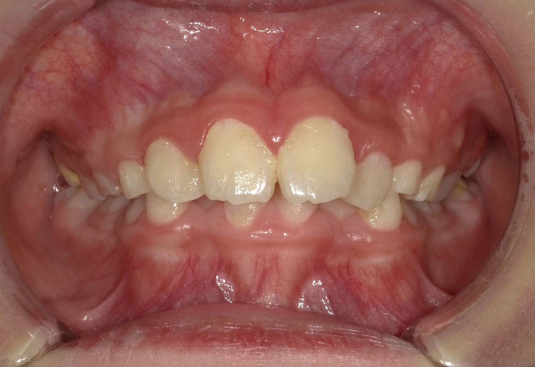 施術前の口内写真01