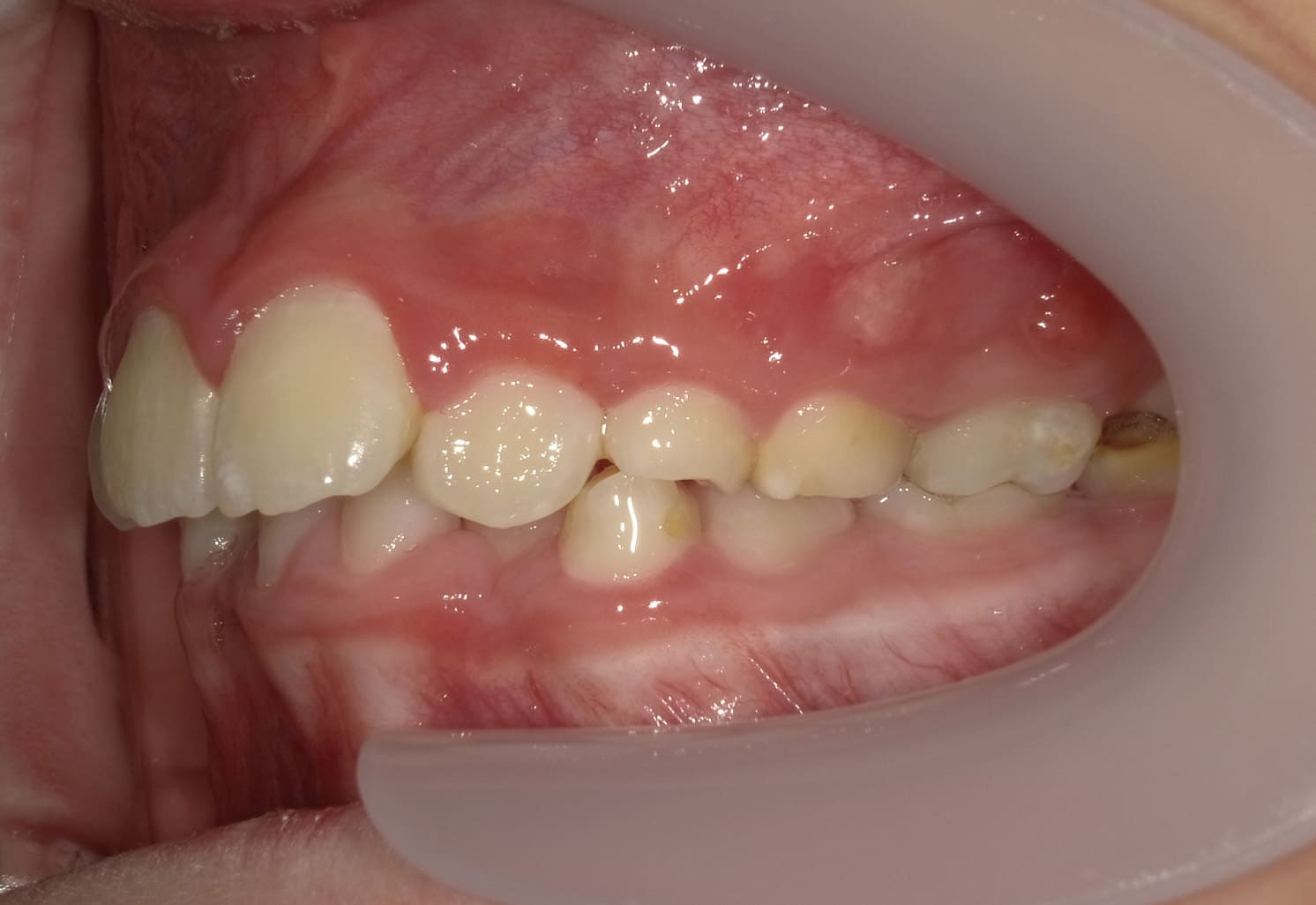 施術前の口内写真03