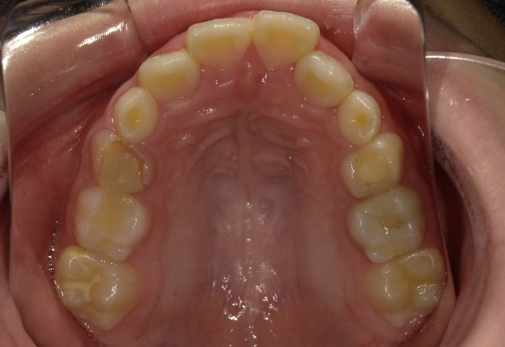 施術前の口内写真04