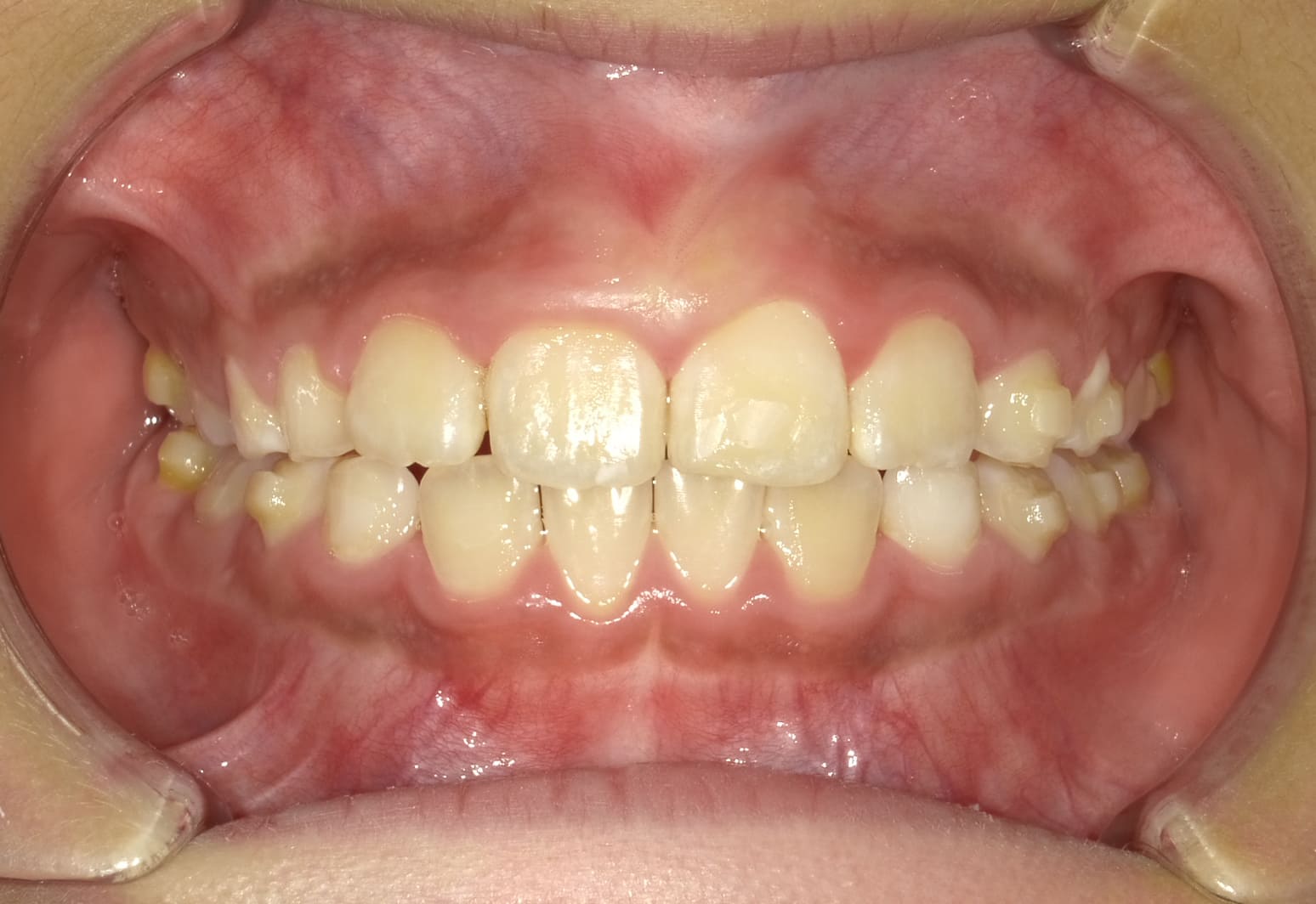 施術後の口内写真01