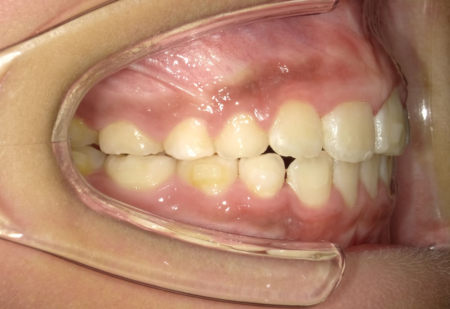 施術後の口内写真02