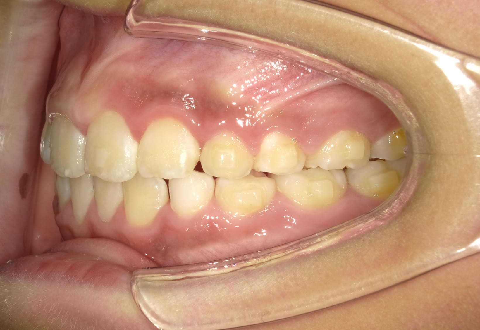 施術後の口内写真03