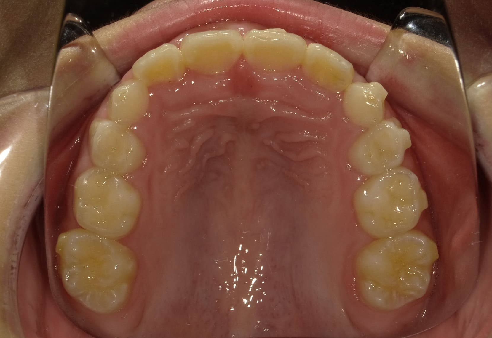 施術後の口内写真04