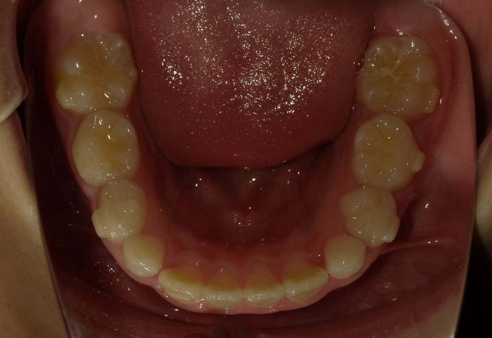 施術後の口内写真05