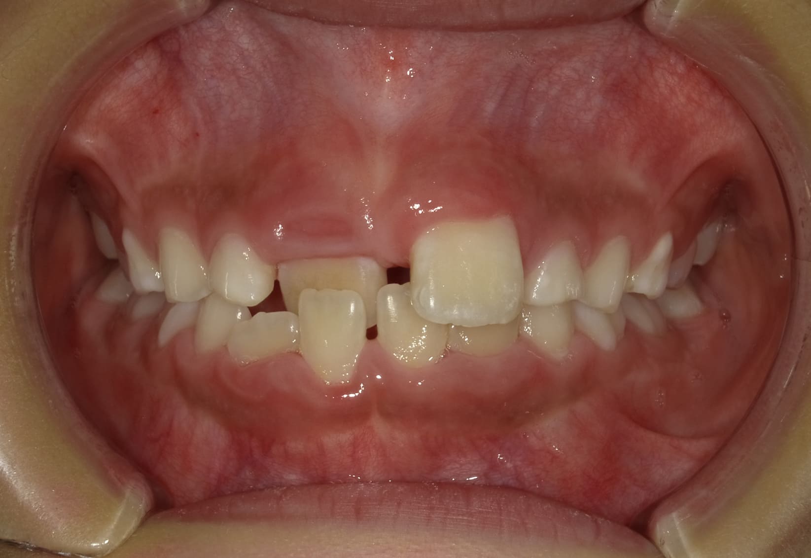 施術前の口内写真01