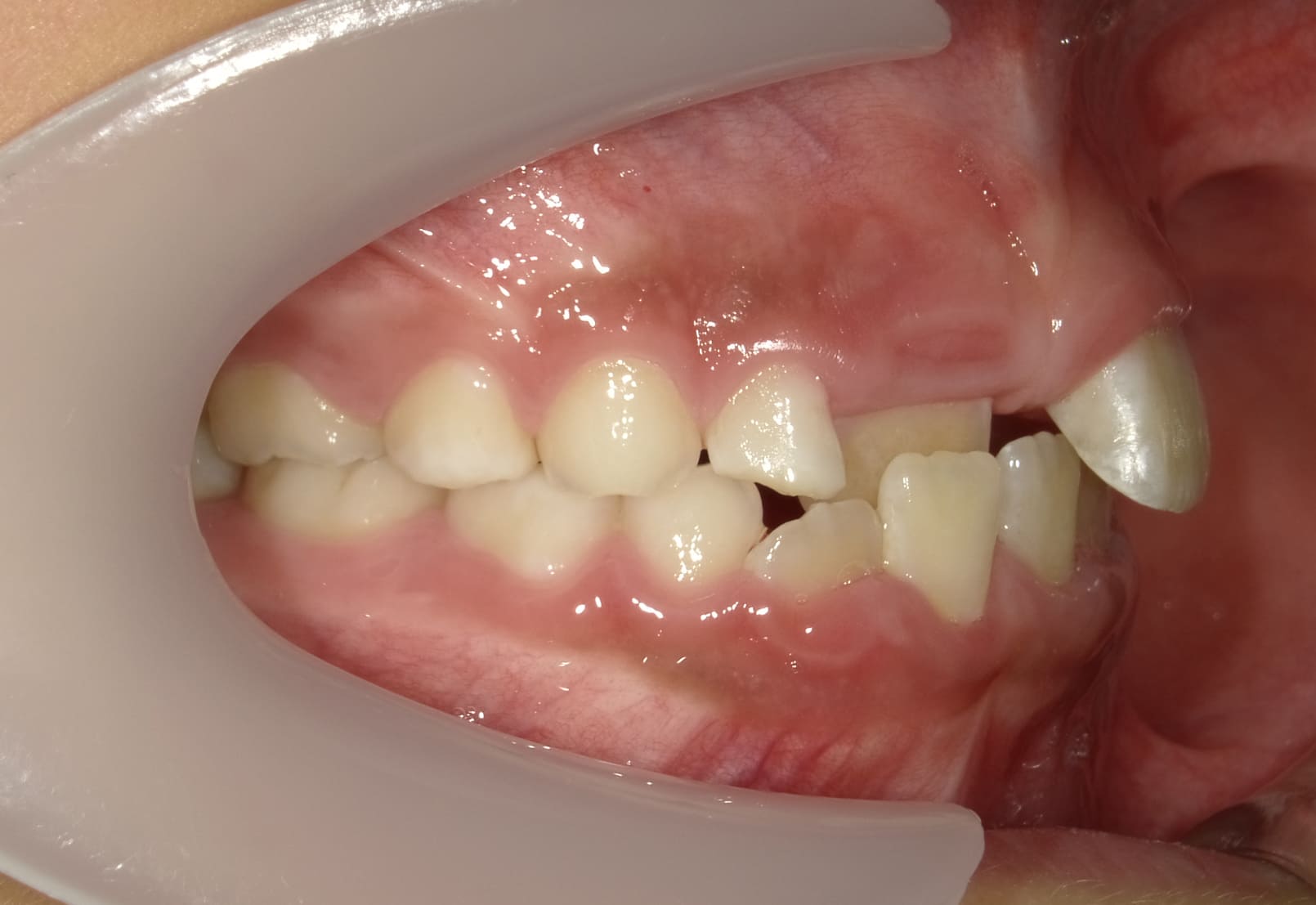 施術前の口内写真02