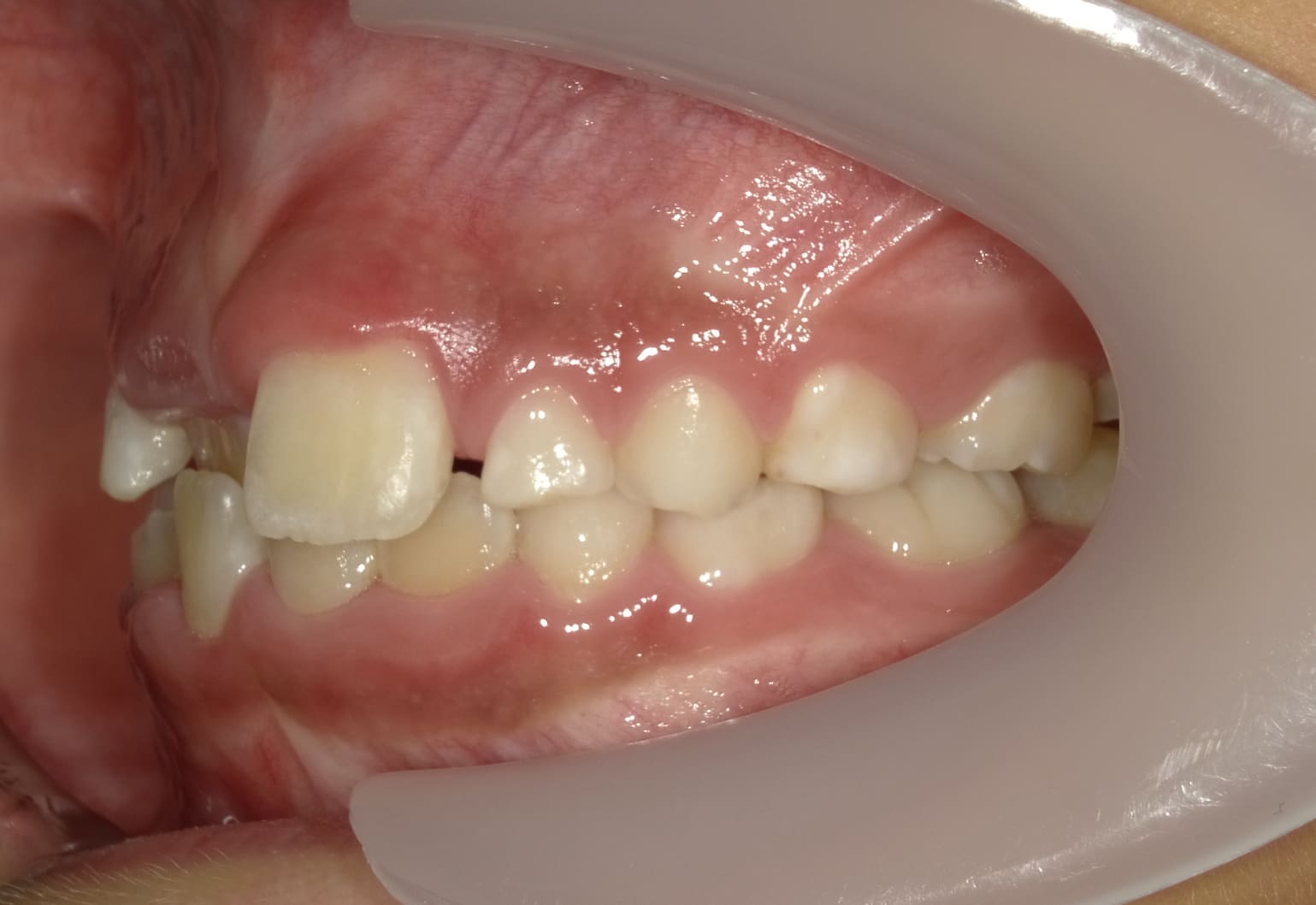 施術前の口内写真03