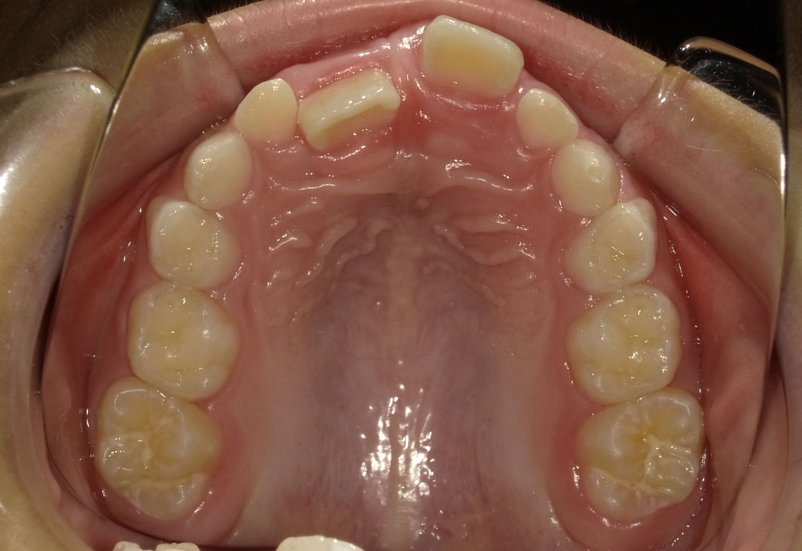 施術前の口内写真04