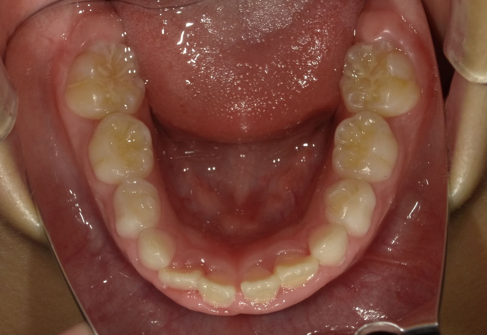 施術前の口内写真05