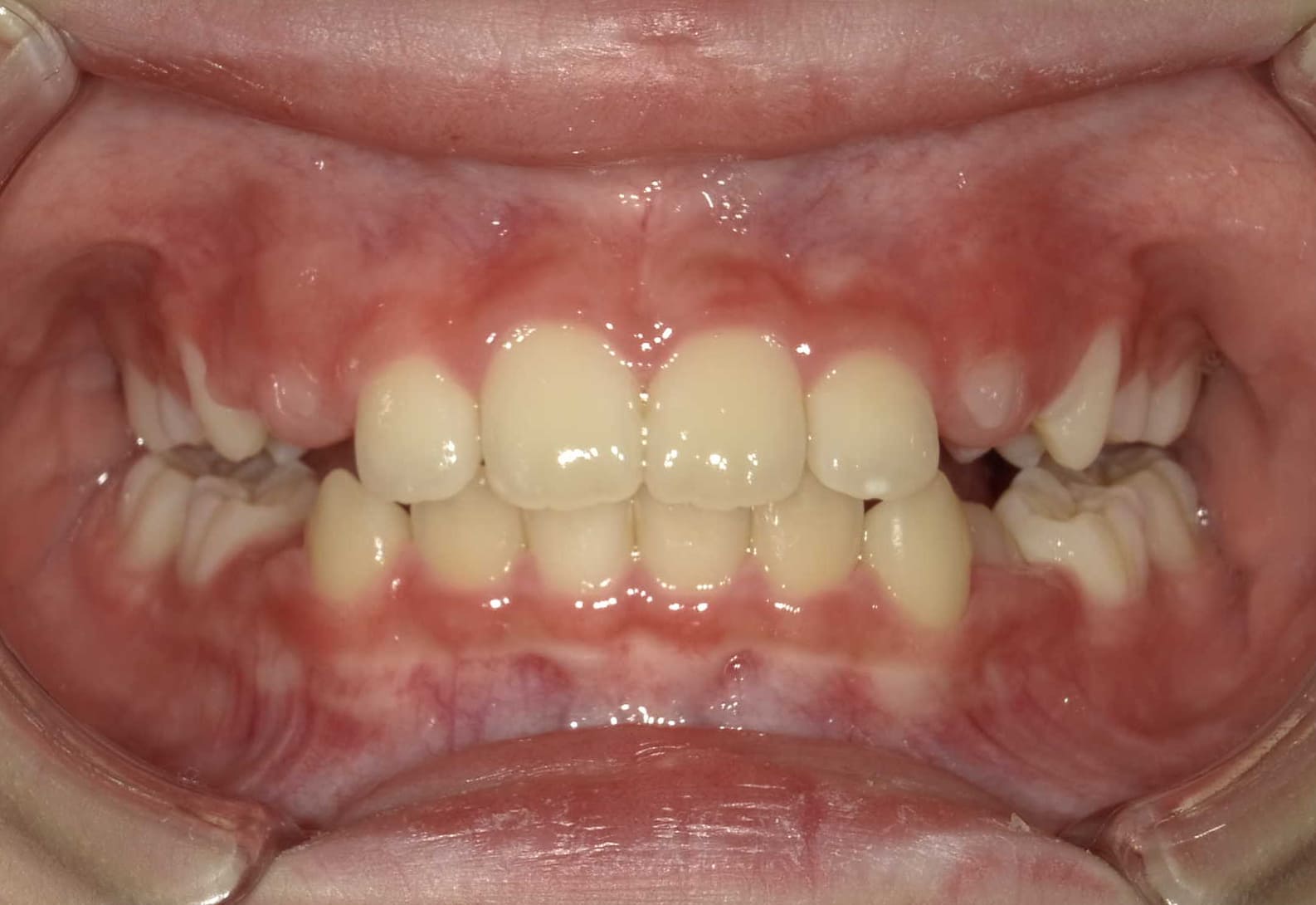 施術後の口内写真01