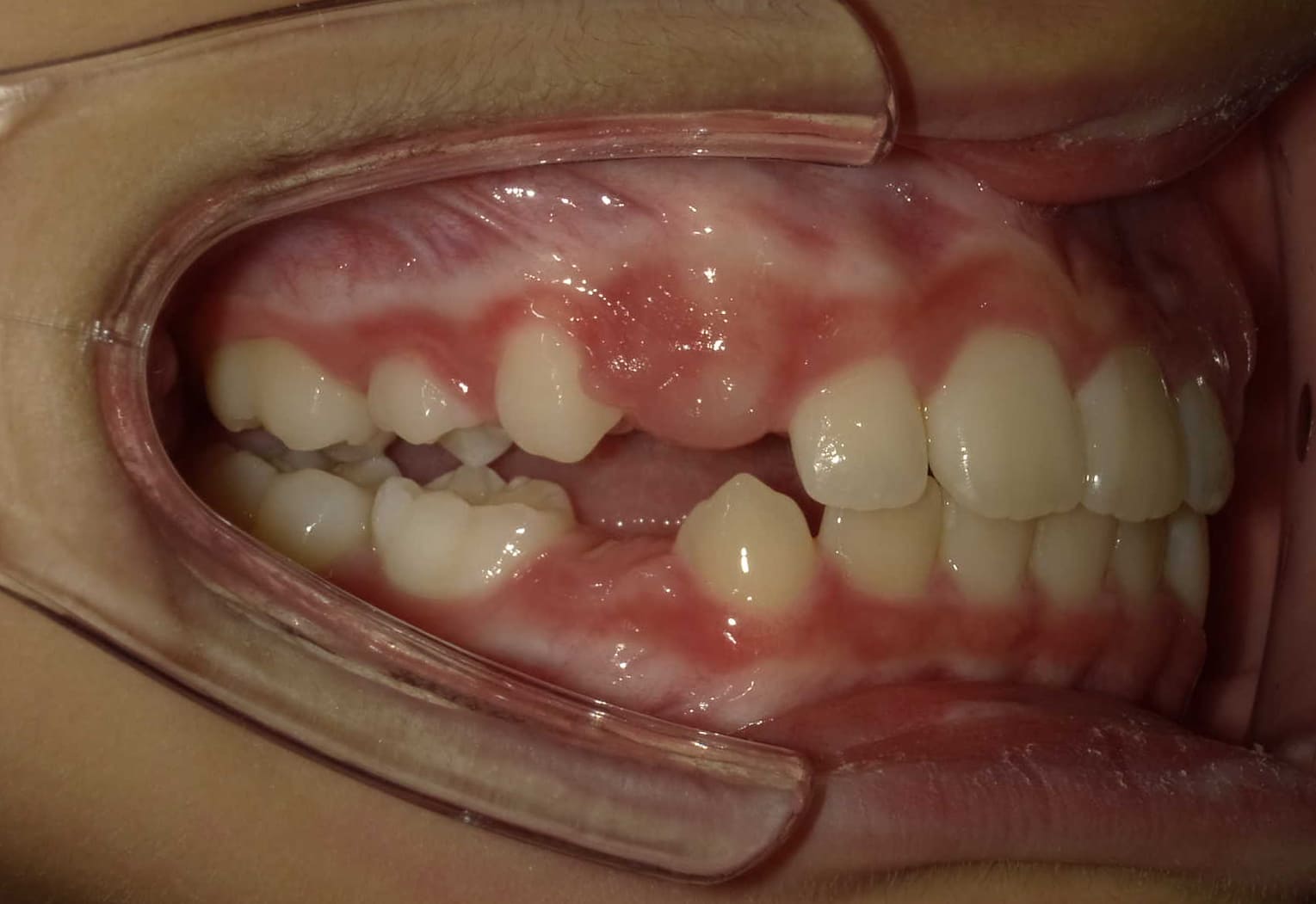 施術後の口内写真02