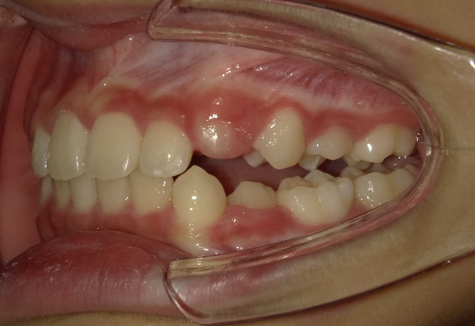 施術後の口内写真03
