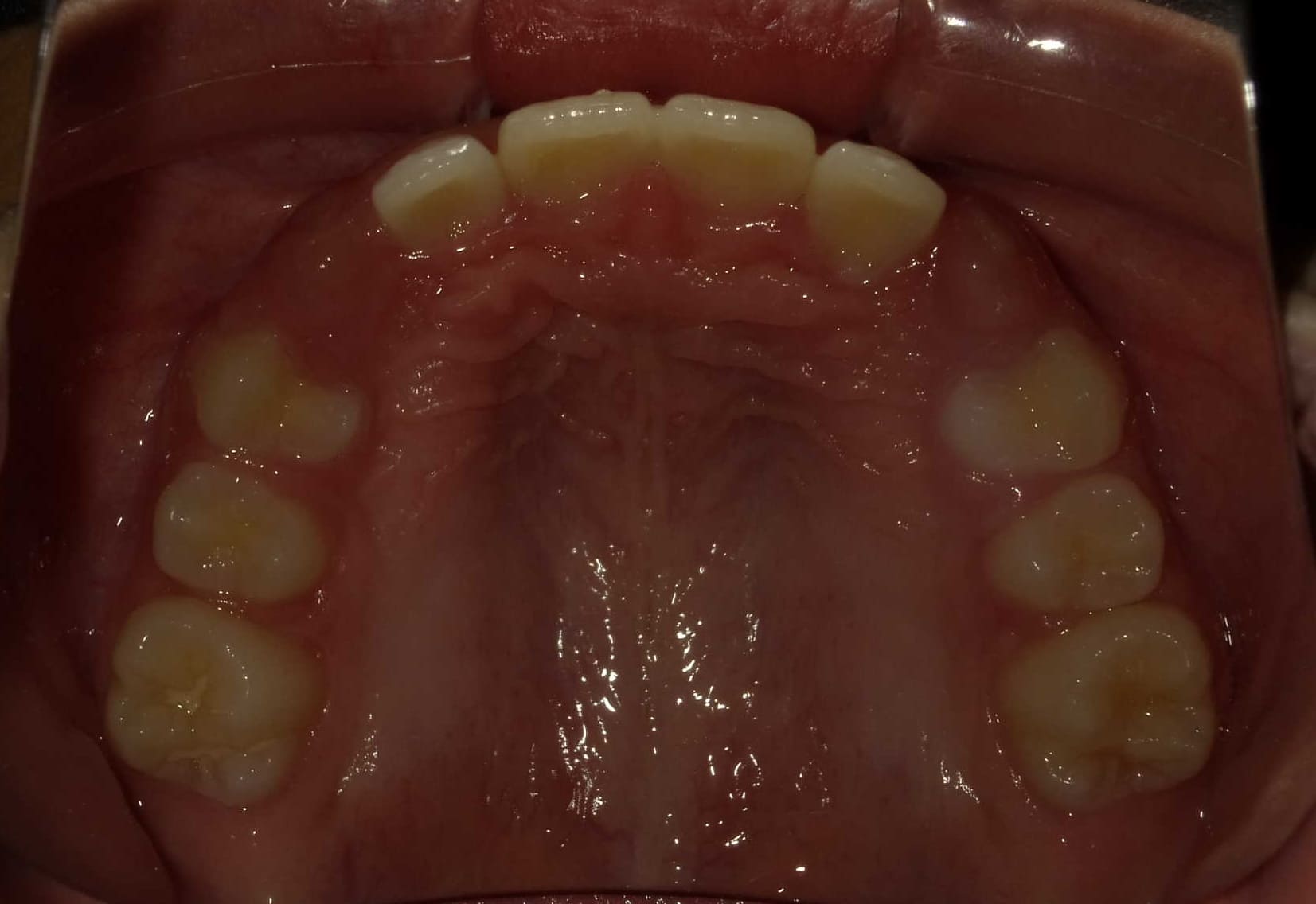 施術後の口内写真04