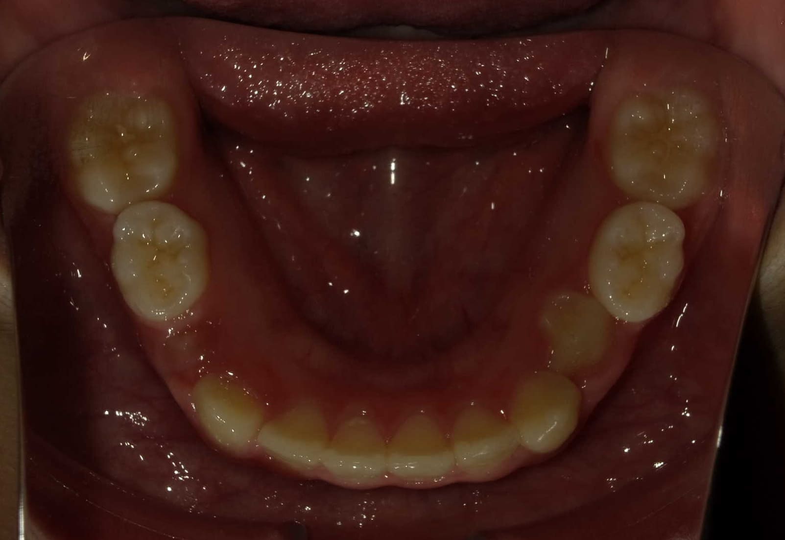 施術後の口内写真05