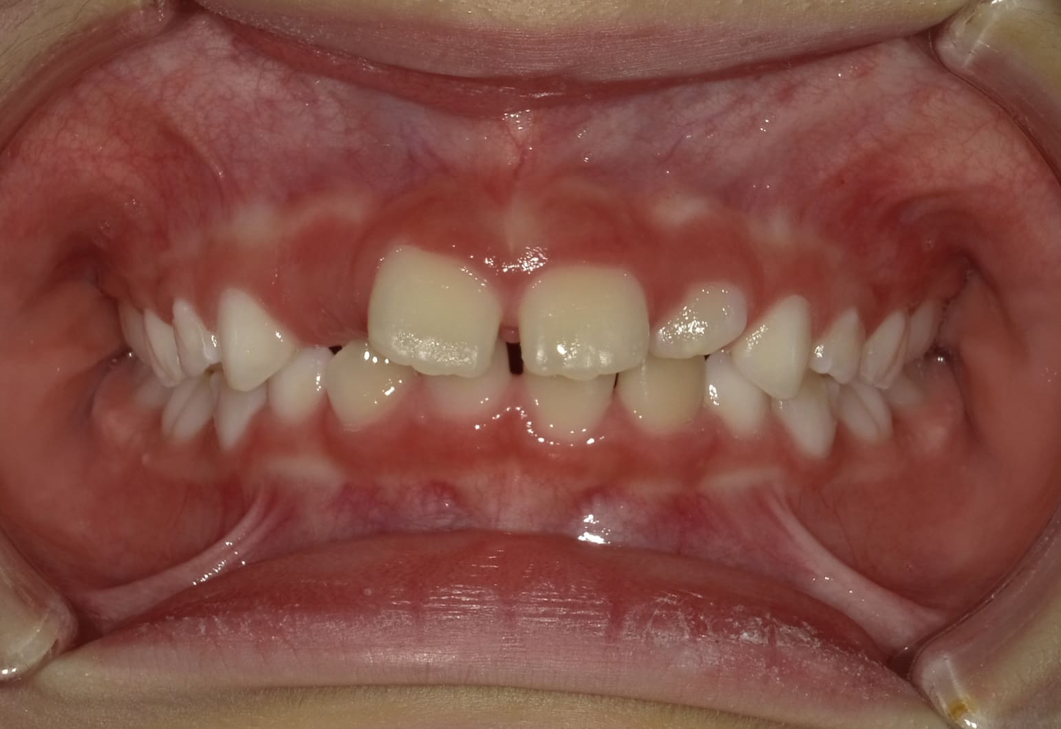 施術前の口内写真01